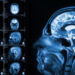 Functional MRI and Neurofeedback